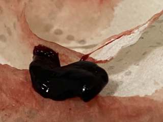 Is this miscarriage?