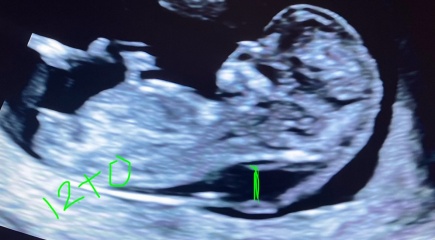 Medical mystery - Very big nuchal fold disappeared within three days