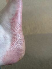 Can anyone help with my eczema? Horrible pics attached!
