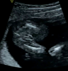 Gender Scan Help!