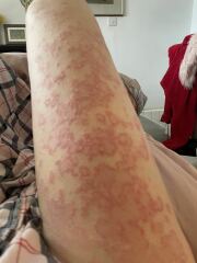 Does this look like a lupus rash?