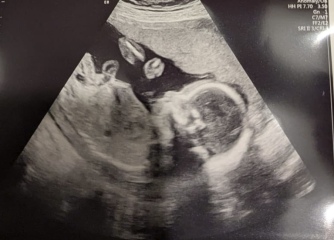 Is my baby a boy?