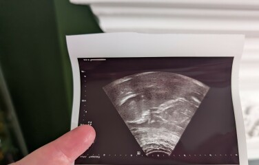 Incomplete 2nd 20 week scan