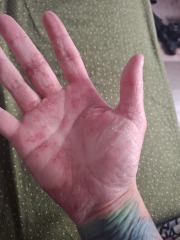 Hand infected (Warning, gross photos)