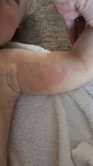 Does anyone know what this rash could possibly be?