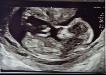 Can you tell the gender?