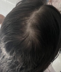 Balding? Thinning? Cowlick?