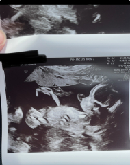 20 weeks gender prediction!