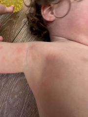 Rash advice on toddler (15 months)