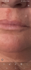 Cold sore or something else
