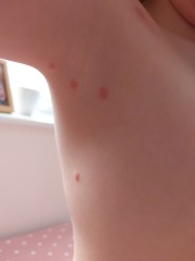 Bug bites or chickenpox?