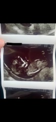 12 week scan gender guesses