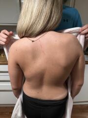 Is this scoliosis ? DD 17