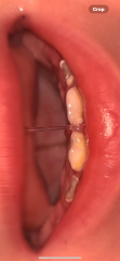 Children’s teeth