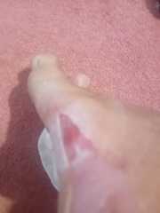 Burst, painful blister..PHOTO ATTACHED