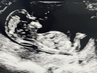 Is there a nub showing on this scan? Help please!!
