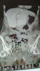Bowel obstruction