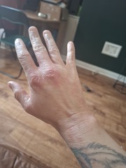 Hand infected (Warning, gross photos)