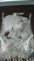 Bowel obstruction