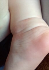 Rash on 5 month old's feet