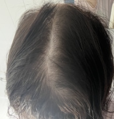 Am I balding