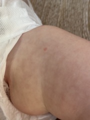 Rash advice on toddler (15 months)