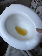 Toddler urine dark? Dehydrated?