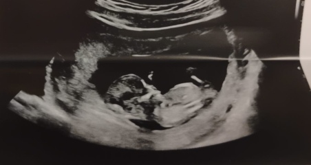 Has anyone been told the gender at 12 week scan?