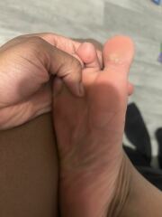 Is this athletes foot ?