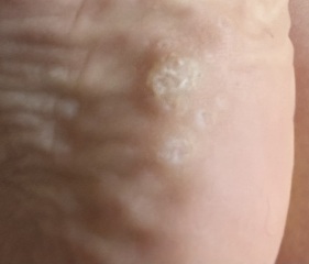 Foot problems