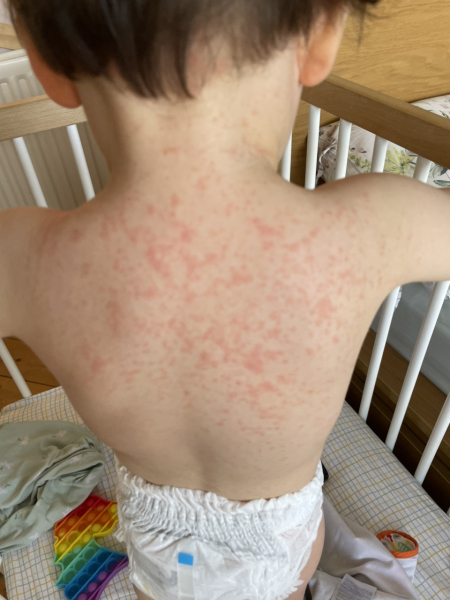 Toddler fever day 5 but otherwise fine