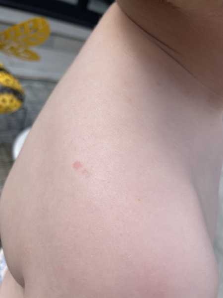 Is this start of chickenpox?