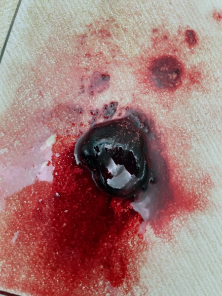 Implantation bleeding or miscarriage?? 😢