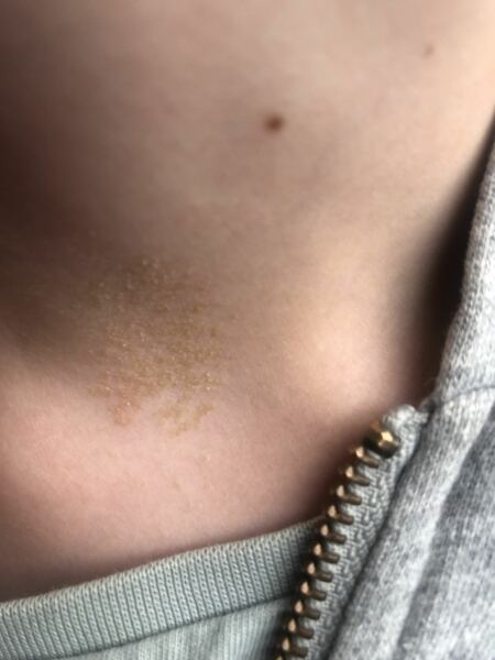 Rough brown mark on child’s neck (pic included)