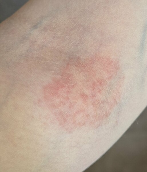 Is this ringworm?
