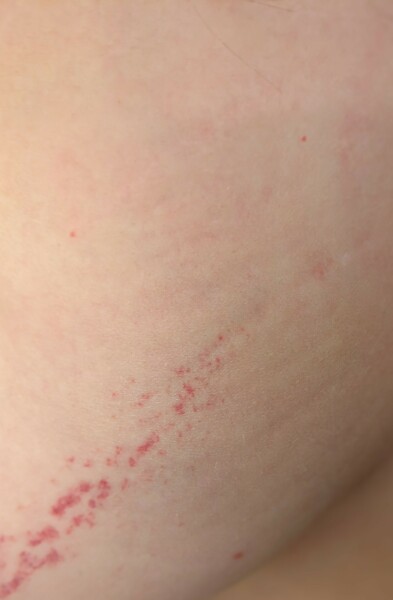 Bruising from light pressure?