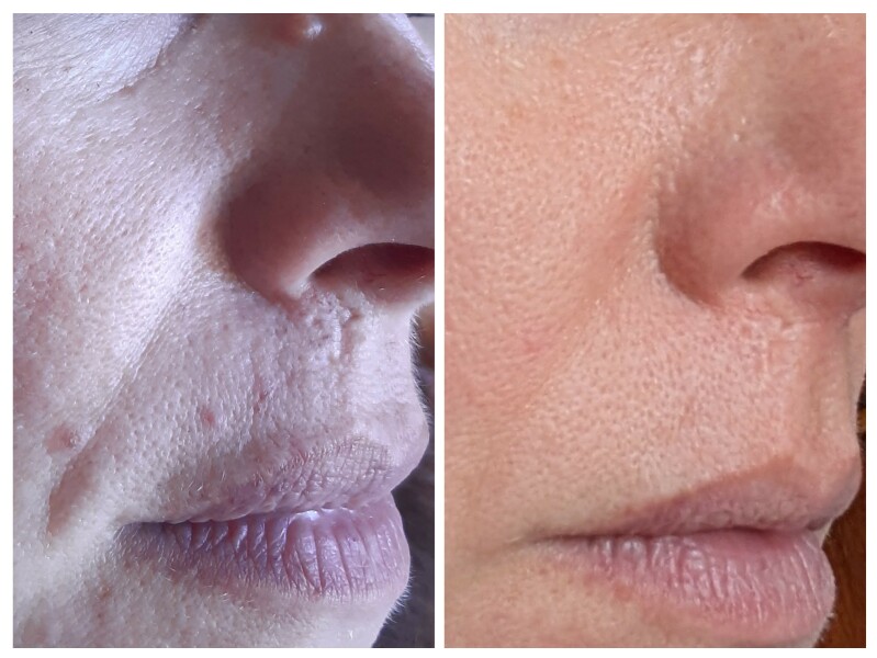 Tretinoin 0.006 - I think I can see an improvement already!! (Pic)