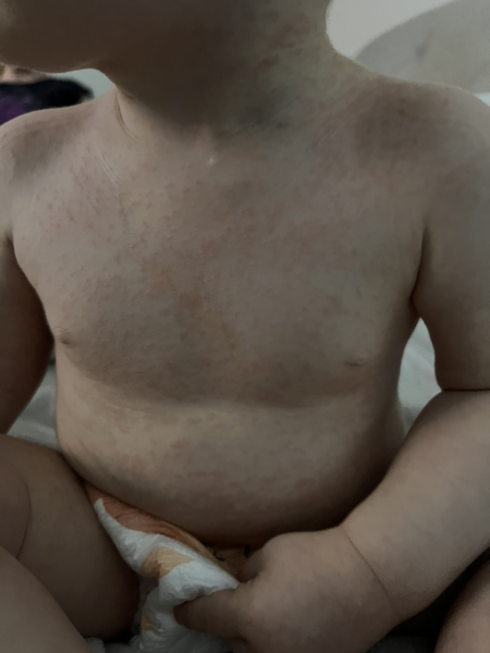 Handhold please - DS aged 1 been admitted to hospital with suspected sepsis