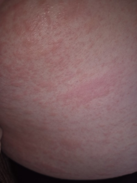 Rash all over breasts and torso