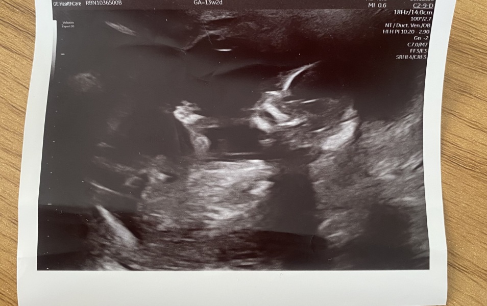 Nasal bone - 12 week scan