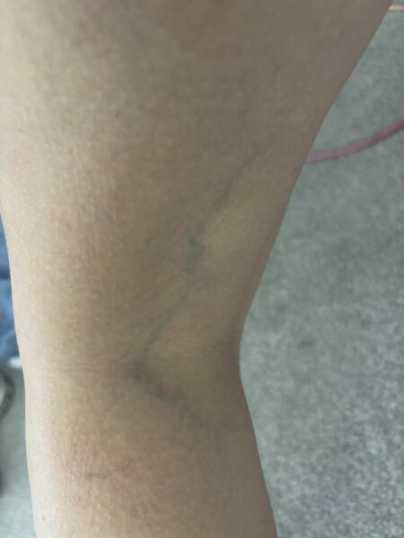 Varicose vein treatment Glasgow