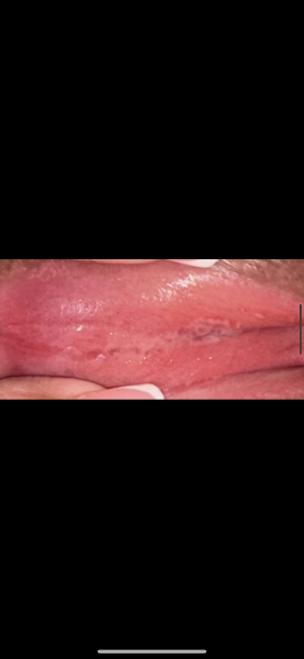 Thrush or herpes? ( Image below tmi )