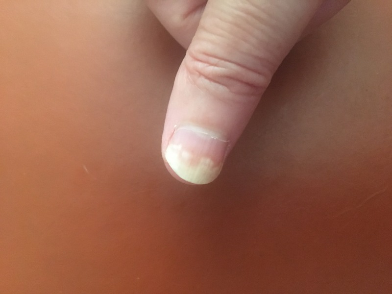What is going on with my nails