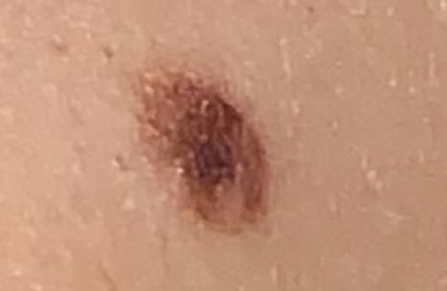 Does this mole look suspicious?