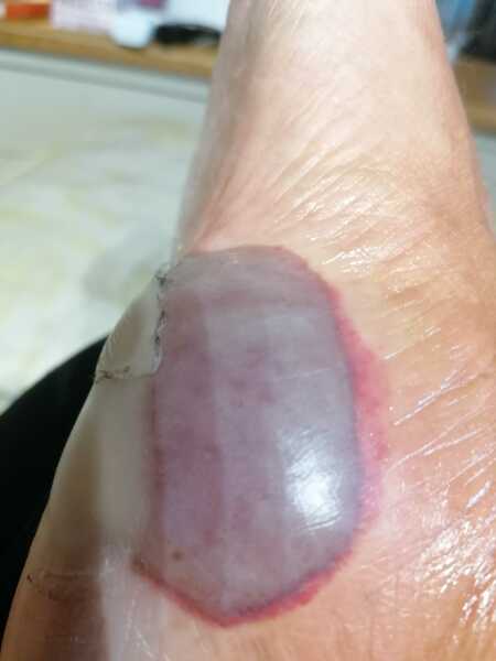 To ask what’s the most ridiculous injury you’ve given yourself?