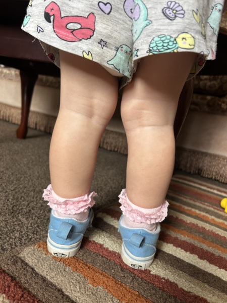 Is this normal? Inner toddler knees.