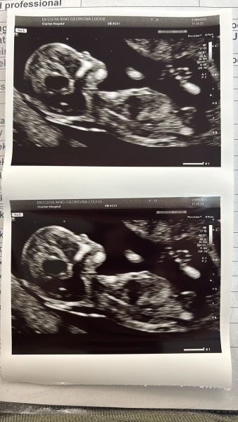 Nub theory, gender guesses, 12 weeks 5 days