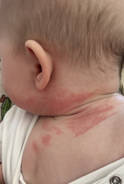 Any rash experts on here?