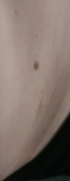 Suspected melanoma