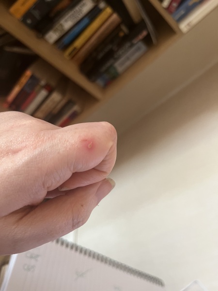 Scratch on my finger could it be infected